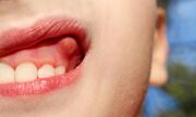 بهترین درمان برای عفونت دندان چیست ؟ (فیلم)