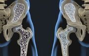حقایق کلیدی در مورد سلامت استخوان