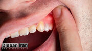 4 روش برای درمان آبسه دندان