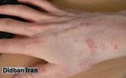 شیوع بیماری مسری «گال» درشهرستان سراوان