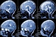 امید تازه دانشمندان برای درمان سرطان کشنده مغز - اکونیوز