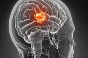انواع تومورهای مغزی و درمان آنها - اکونیوز