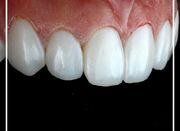 بهترین مرکز کامپوزیت ونیر دندان در جردن - اکونیوز