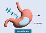 بوتاکس معده چیست و چطور باعث لاغری می شود(مزایا+عوارض) - اکونیوز