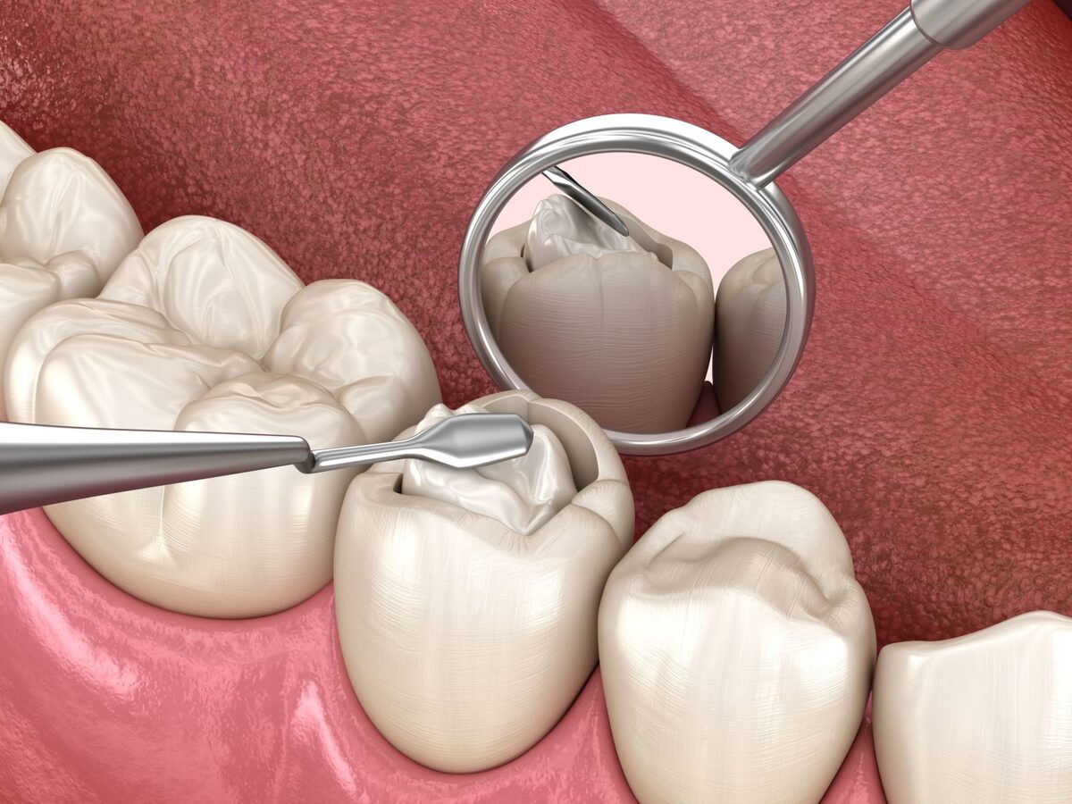 مایع ارزانی که دندان‌ها را از پوسیدگی نجات می‌دهد