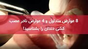 ۸ عوارض متداول و ۴ عوارض نادر عصب کشی دندان را بشناسید