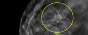 ماموگرافی برای غربالگری سرطان از ۴۰ سالگی