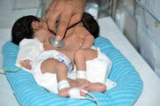 دوقلوهای به هم چسبیده اهوازی جدا شدند | دخترها ۱۰ ساعت در شیراز زیر تیغ جراحی بودند