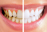 ۷ دلیل اصلی زرد شدن دندان‌ها | راهکارهایی که دندان‌ها را دوباره سفید می‌کند