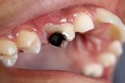 کدام بیماری‌ها از طریق پوسیدگی دندان منتقل می‌شود؟