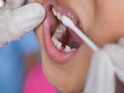 ماده‌ای که ۴۰ درصد از پوسیدگی‌ دندان پیشگیری می‌کند