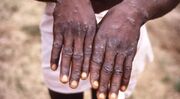 شیوع بیماری کشنده در آفریقا
