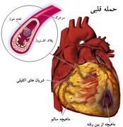 حمله قلبی ویا سکته قلبی چیست ؟
