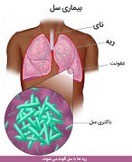 سونامی بیماری سل در ایران ؛ بیش از ۷ هزار نفر مبتلا شدند