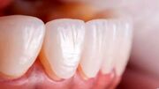 چگونه عمر لمینت دندان هایتان را افزایش بدهید؟