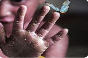 آمریکا به دلیل تحریم کودکان پروانه‌ای ۶ میلیارد دلار محکوم شد