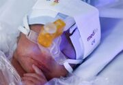 پیشگیری از نابینایی ۲۸۰ نوزاد در فارس با درمان رتینوپاتی