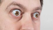 بیماری بیرون‌زدگی چشم چیست؟ + فیلم