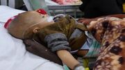 افزایش کودکان مبتلا به سوءتغذیه در افغانستان