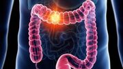 عوامل موثر در بروز سرطان روده / تغییر اجابت مزاج را جدی بگیرید