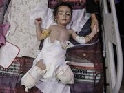 Gaza toddlers got the polio vaccine, then an Israeli bomb took their legs