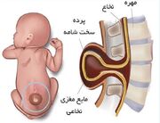 ابتلا ۲ میلیون ایرانی به «مننگوسل»/ تشخیص زودهنگام از نارسایی کلیه و دیالیز کودکان جلوگیری می‌کند