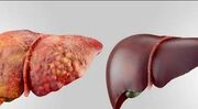 راه قطعی تشخیص کبد چرب کدام است؟ آزمایش یا سونوگرافی؟