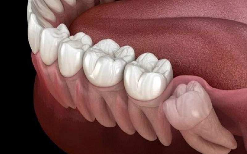 بیماری لثه خطر سکته مغزی را افزایش می‌دهد