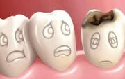 راز پوسیدگی دندان کشف شد