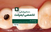 دندانپزشکی تخصصی ایمپلنت