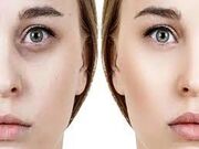 بهترین دکتر برای تزریق فیلر زیر چشم کیست؟