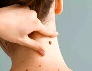 هزینه برداشتن خال گوشتی در سال 1404 چقدر است؟