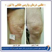 واریس پا را چه زمانی باید درمان کرد؟ علائمی که نباید نادیده بگیرید