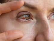 دلایل پارگی رگ خونی در چشم؛ چه موقع به پزشک مراجعه کنیم؟