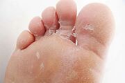 پاهایتان بی‌دلیل پوسته می‌دهند؟ این علت‌ها را جدی بگیرید