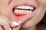 جایگزین طبیعی آنتی‌بیوتیک برای درمان بیماری لثه