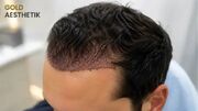 بهترین دکتر کاشت مو در آلمان را چگونه انتخاب کنیم؟