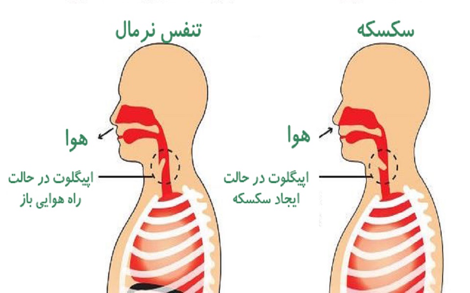 سکسکه طولانی‌مدت؛ چه زمانی نشانه بیماری جدی است؟
