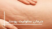 درمان خانگی سلولیت‌ها با ۵ روش ساده و طبیعی