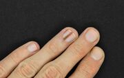 هر لکه و خط روی ناخن یک هشدار است/ اینفوگرافیک