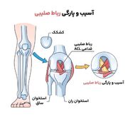 جراحی رباط صلیبی با پرده جفت جنین