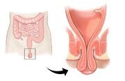 هر نوع بیرون زدگی مقعدی سرطان است؟