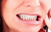 هشدار درباره عوارض جدی دندان‌قروچه و تهدید سلامت ترمیم‌های دندانی