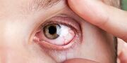 خشکی چشم می‌تواند اولین نشانه این بیماری‌ها باشد!