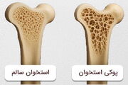 کشف نقش ویژه این ویتامین در جلوگیری از پوکی استخوان