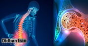 بروز پوکی استخوان در ۶۰ درصد ایرانیان بالای ۵۰ سال