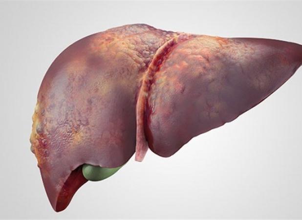 درمان قطعی کبد چرب/ دلایل ابتلا چیست؟ - اکونیوز