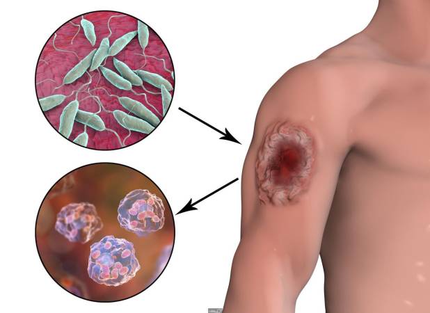 کاهش ابتلا به سالک طی ۲ دهه گذشته - اکونیوز
