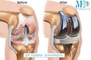 تعویض مفصل زانو و لگن: راهی برای بازگشت به زندگی - اکونیوز