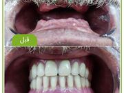 پروتز دندان چیست و چه انواعی دارد؟ - اکونیوز